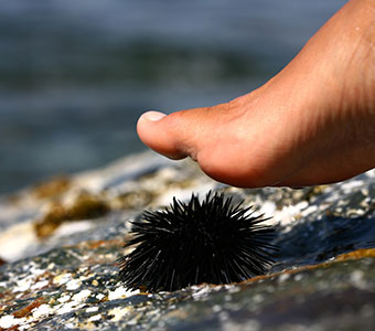 Ask DAN: How do you treat sea urchin stings? | DAN Worldwide